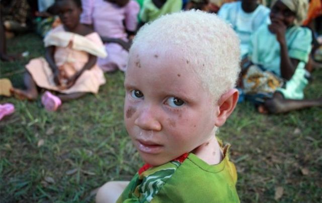 African Albinos (8 pics)