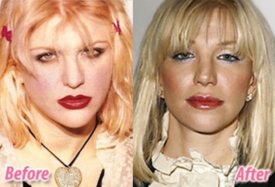 Stars before and after plastic surgery (47 pics)