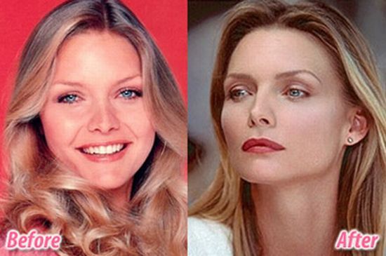 Stars before and after plastic surgery (47 pics) - Izismile.com