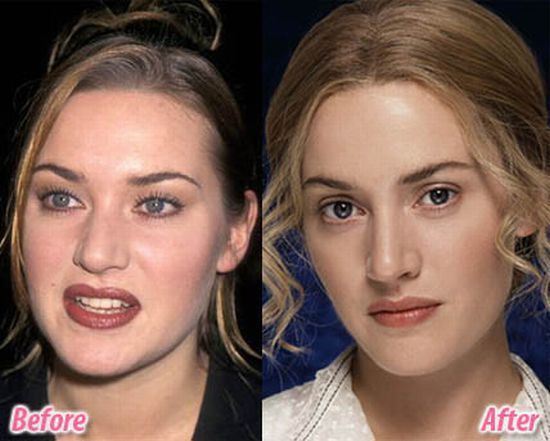 Stars before and after plastic surgery (47 pics)