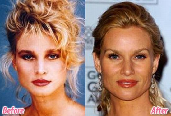 Stars before and after plastic surgery (47 pics) - Izismile.com