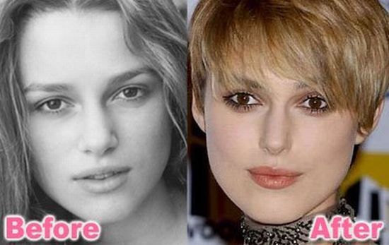 Stars before and after plastic surgery (47 pics)
