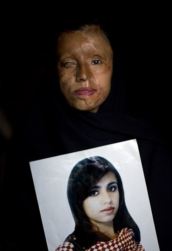 OMG of the Day. “Acid Terrorism” Against Women in Pakistan (12 pics + text)