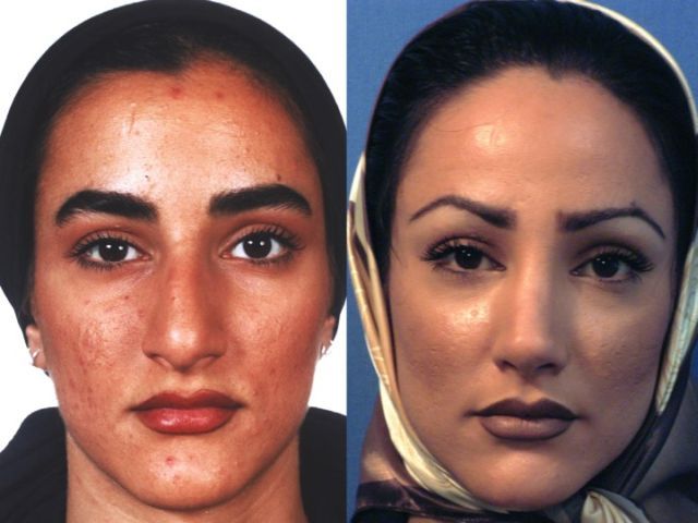 Before and After a Nose Job (24 pics)