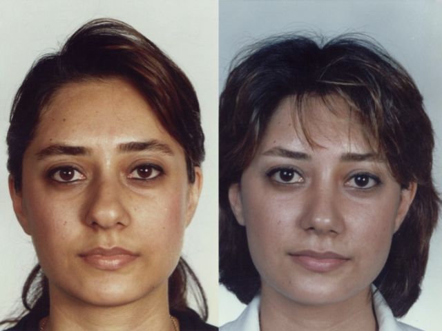 Before and After a Nose Job (24 pics)