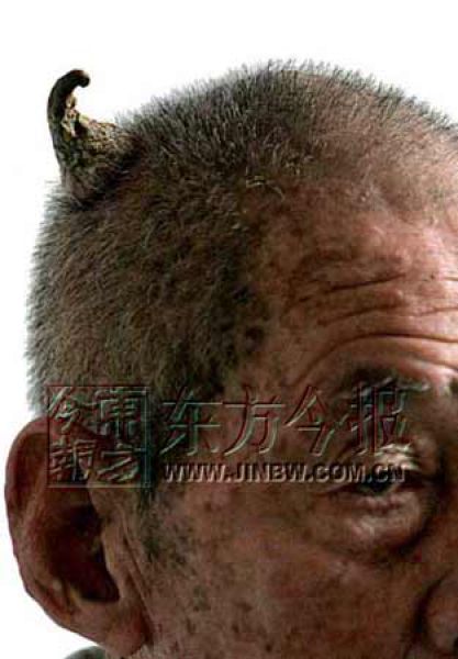 People Who Grow Real Horns (9 pics)