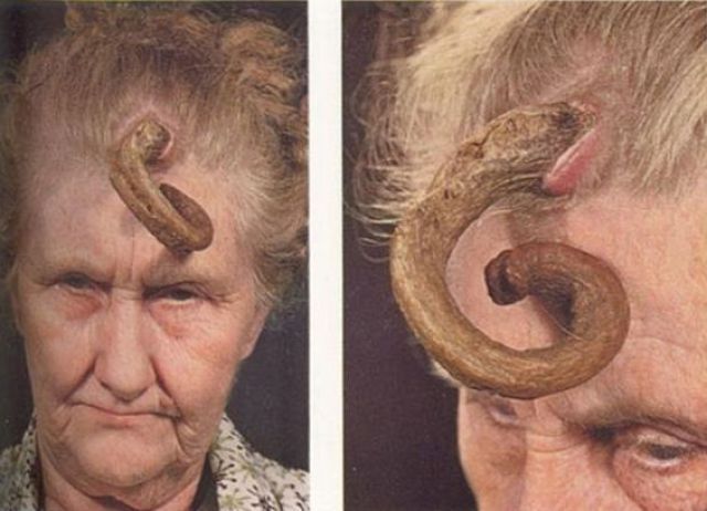 People Who Grow Real Horns (9 pics)
