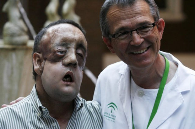 The Results of the Second Face Transplant in Spain (11 pics)