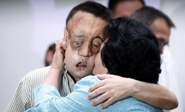 The Results of the Second Face Transplant in Spain (11 pics)
