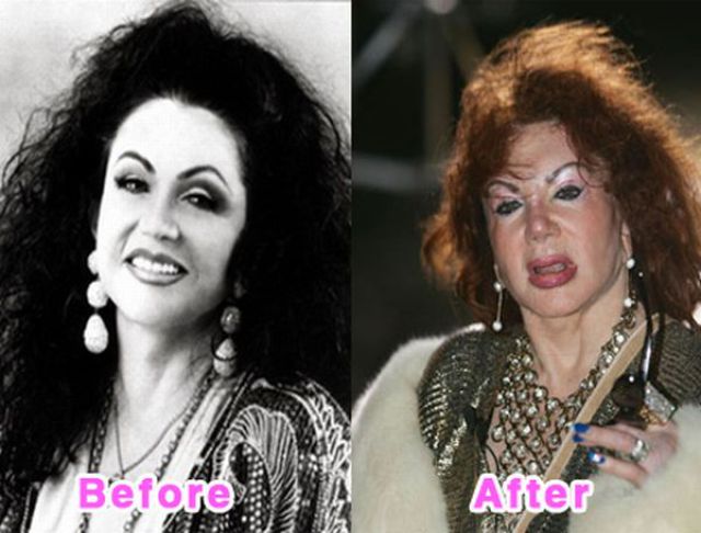 Celebrity Plastic Surgery Before and After Photos (16 pics)