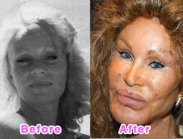 Celebrity Plastic Surgery Before and After Photos (16 pics)