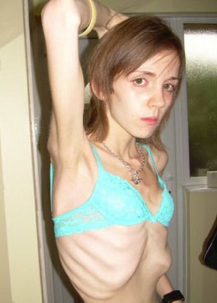 How Mom Saved Her Anorexic Daughter