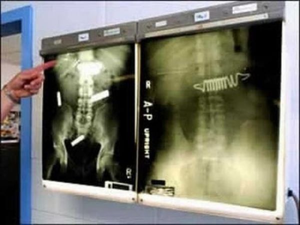 Amazing X Rays