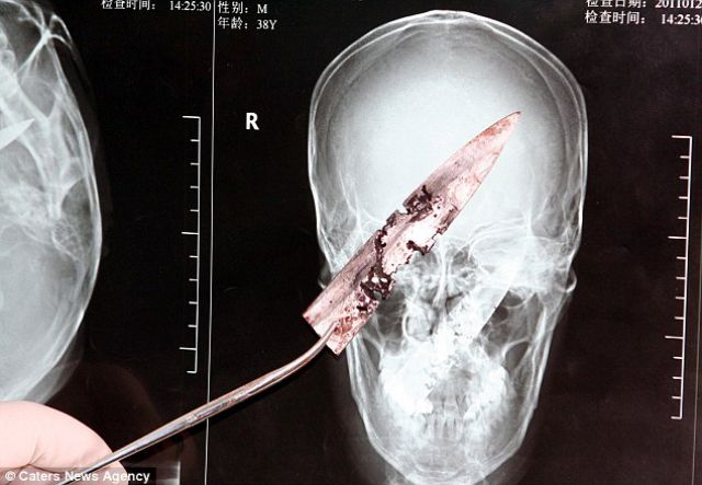 X-rays Reveal 4-Inch KNife Buried in Man
