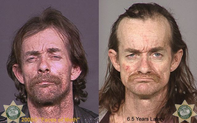 Meth Addicts Before And After Pics Izismile Com