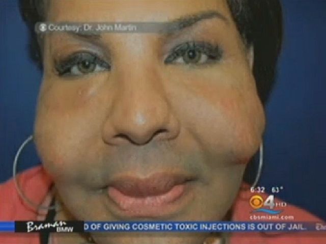 Proof That Injecting Cement Into A Face Is a Bad Idea