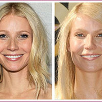 Celebrity Plastic Surgery Before & After (56 pics) - Picture #22 ...