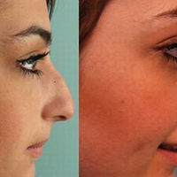 Celebrity Plastic Surgery Before & After (56 pics) - Picture #22