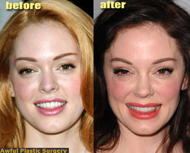 Celebrity Plastic Surgery Before &amp; After (56 pics ...
