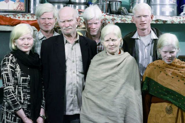 The Largest Albino Family in the World