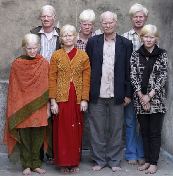 The Largest Albino Family in the World