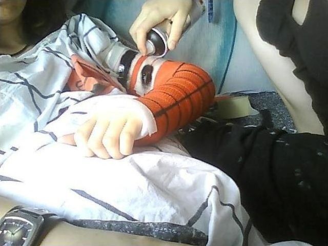 Spiderman Cast for a Broken Arm