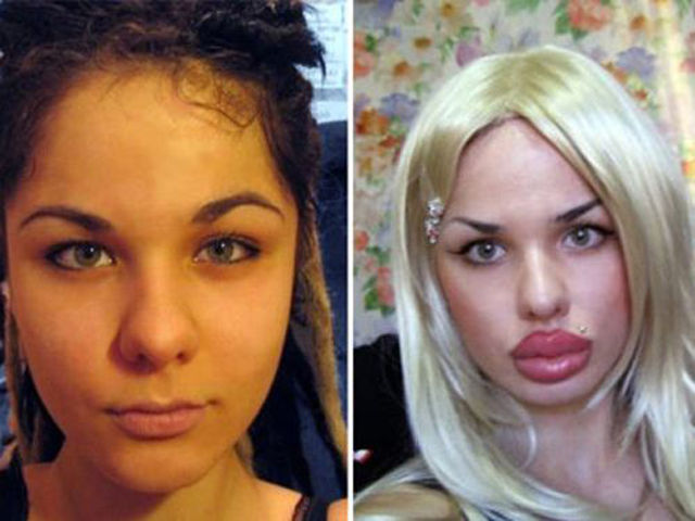 When Plastic Surgery Goes Really Wrong