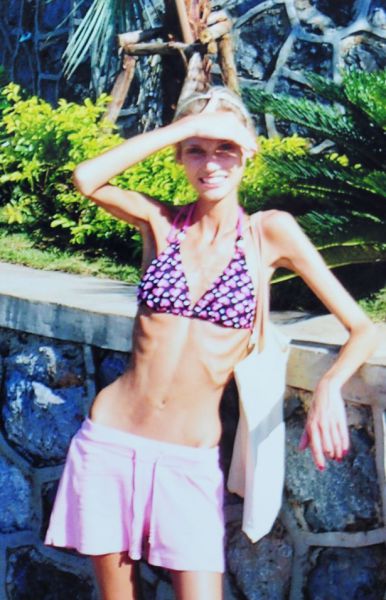 Astonishing Recovery from Anorexia