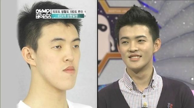 Before and After Photos of Korean Plastic Surgery