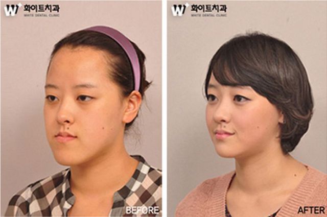 Before and After Photos of Korean Plastic Surgery