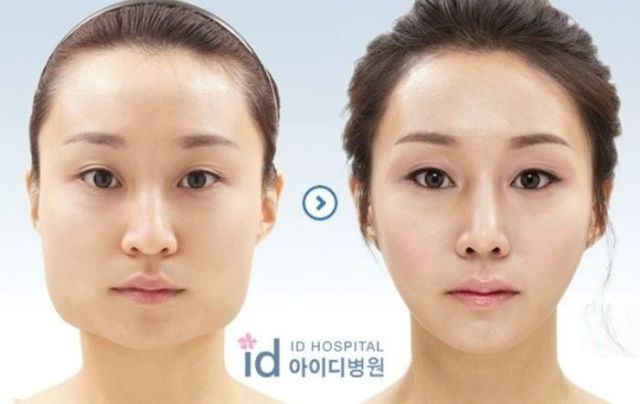 Before And After Photos Of Korean Plastic Surgery 30 Pics 1116