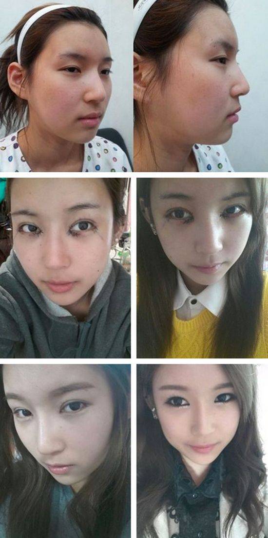 Before and After Photos of Korean Plastic Surgery (30 PICS