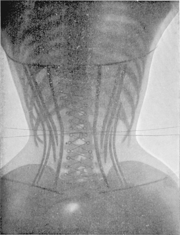 X-Rays Show the Real Effects of a Corset on a Woman’s Body