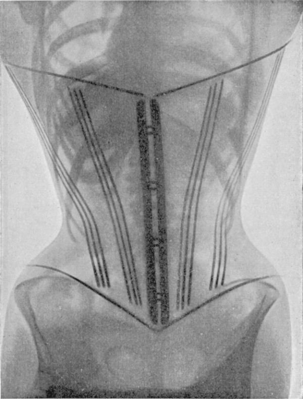 X-Rays Show the Real Effects of a Corset on a Woman’s Body