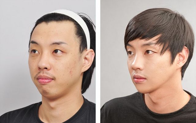 Before and After Photos of Korean Plastic Surgery. Part 2 (62 PICS)