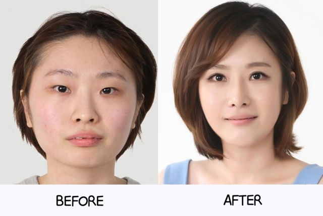 Before and After Photos of Korean Plastic Surgery. Part 2 (62 PICS)