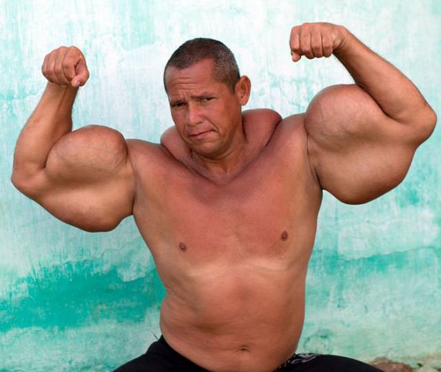 The Man Whose Monster Arms Might Actually Kill Him