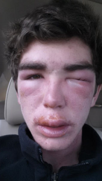 The Mad Effects of Bee Stings on Faces
