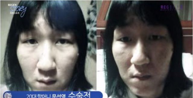 Korean Woman Gets a Whole New Face Shape