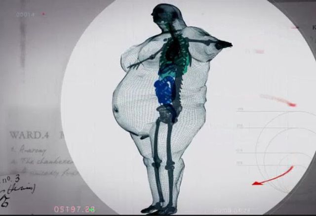 A Revealing X-Ray Image of What an Obese Man Really Looks Like