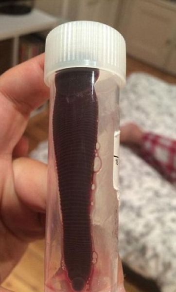 This Girl Found a Gross Creature Hiding in Her Nose