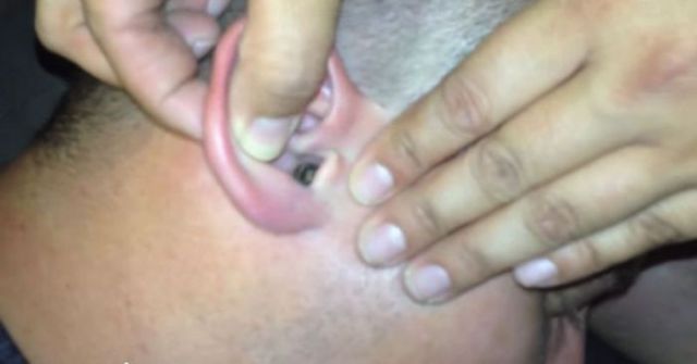 This Guy Has Something Gross Lodged in His Ear