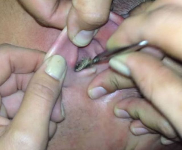 This Guy Has Something Gross Lodged in His Ear