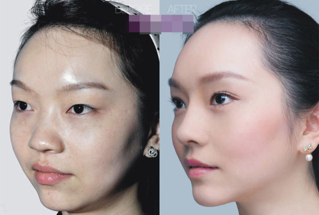 Plastic Surgery Is All the Rage in China