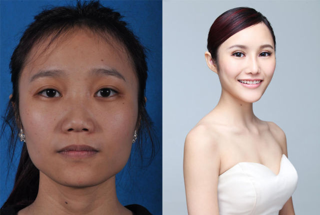 Plastic Surgery Is All the Rage in China