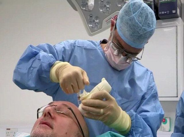 A Hair Transplant Surgery Fail