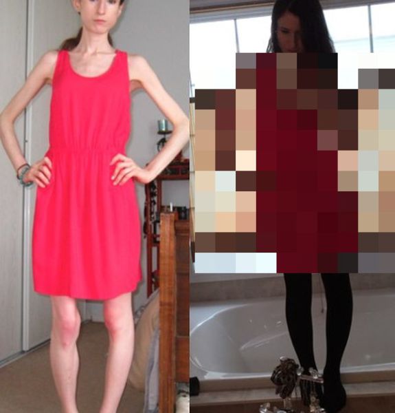 A Drastic Eating Disorder Recovery That Is Truly Amazing