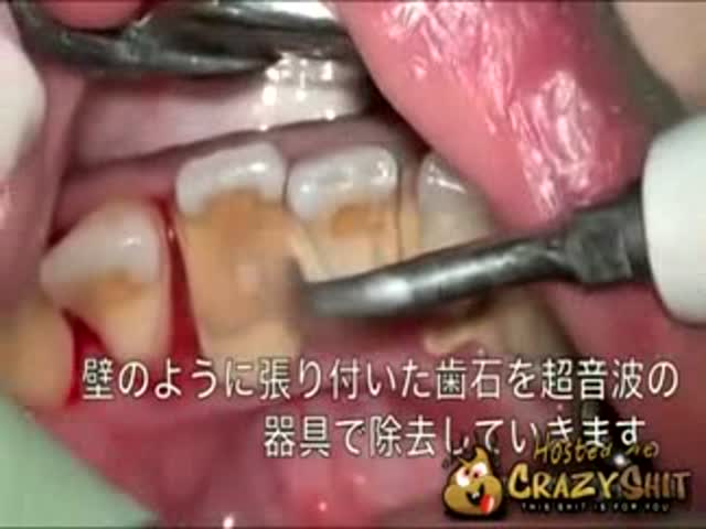 Extreme Tooth Scaling  (VIDEO)