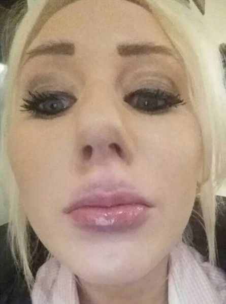 A Kylie Jenner Lip Job That Goes Terribly Wrong