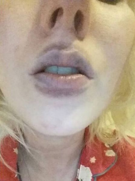A Kylie Jenner Lip Job That Goes Terribly Wrong
